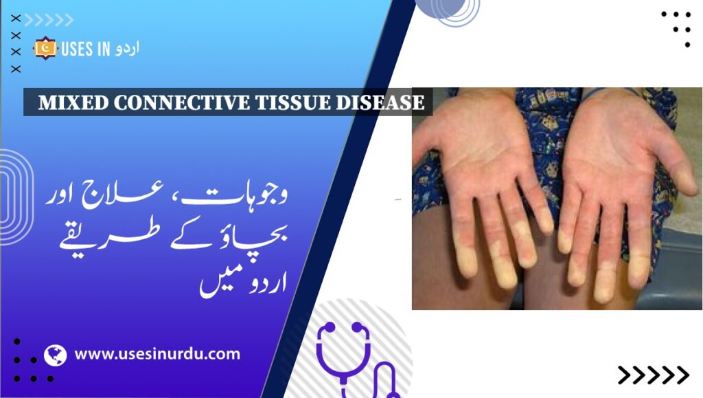 Mixed Connective Tissue Disease