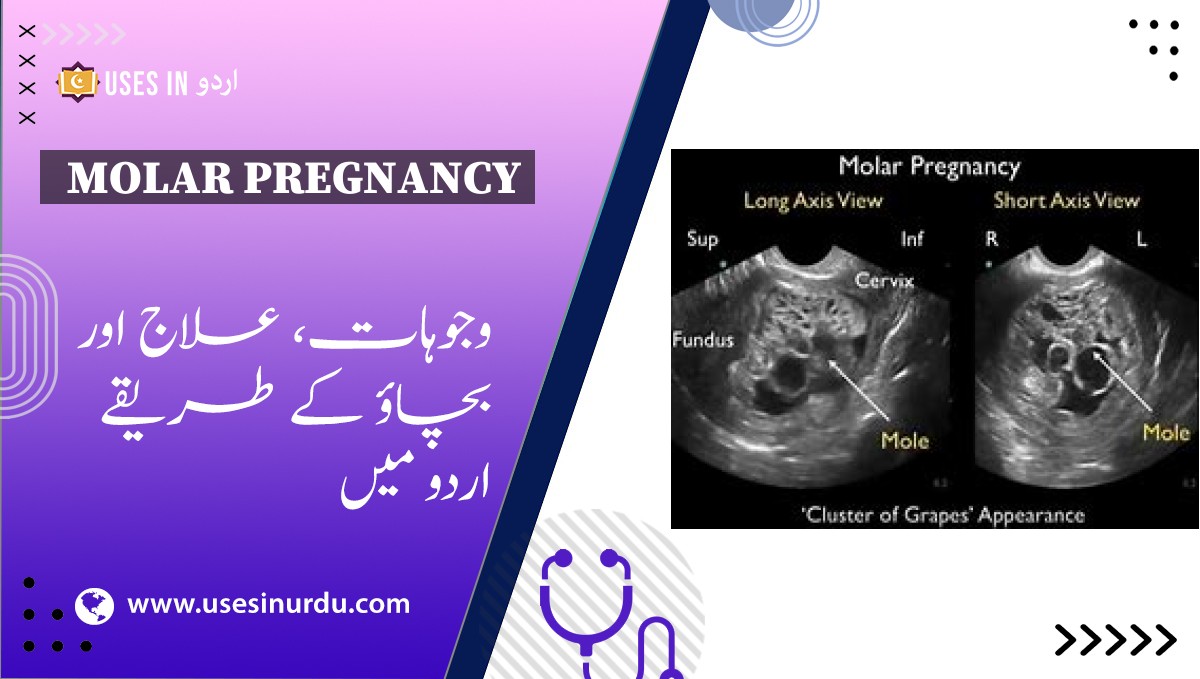 Molar Pregnancy