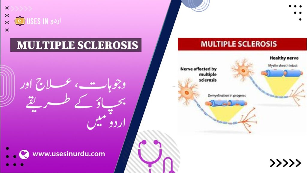 Multiple Sclerosis