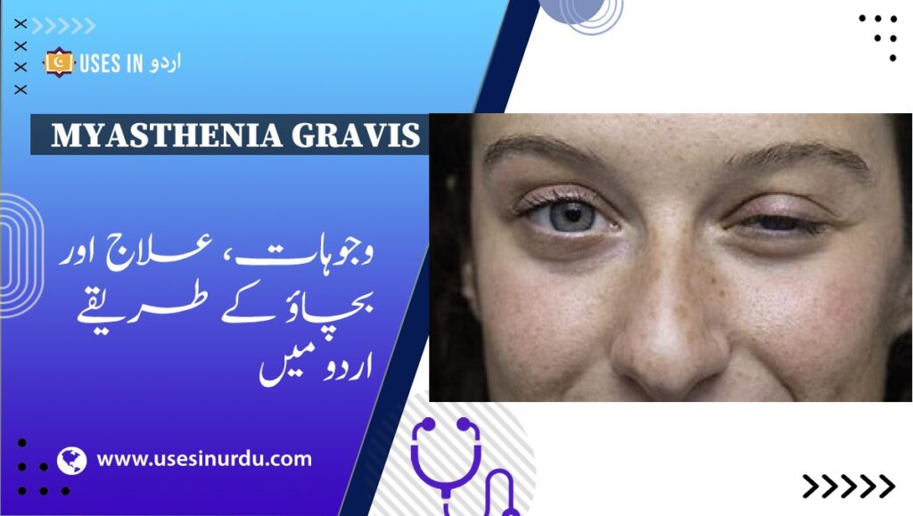 Myasthenia Gravis