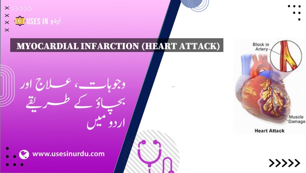 Myocardial Infarction (Heart Attack)