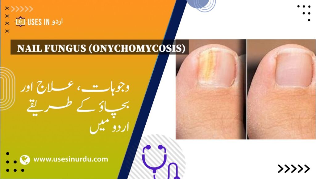 Nail Fungus (Onychomycosis)