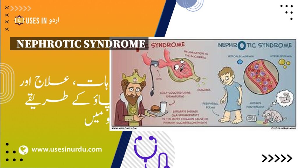 Nephrotic Syndrome