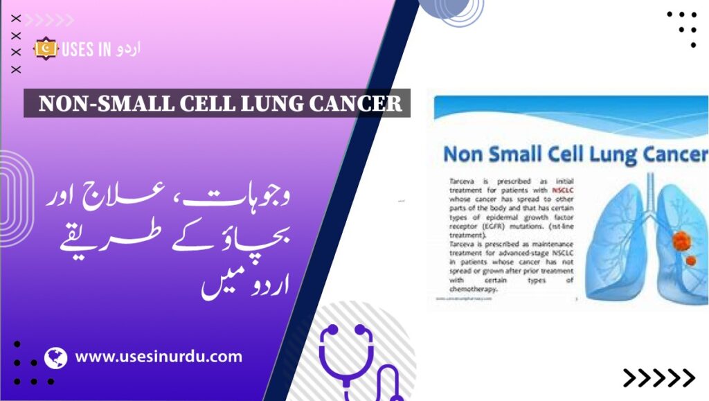 Non-Small Cell Lung Cancer