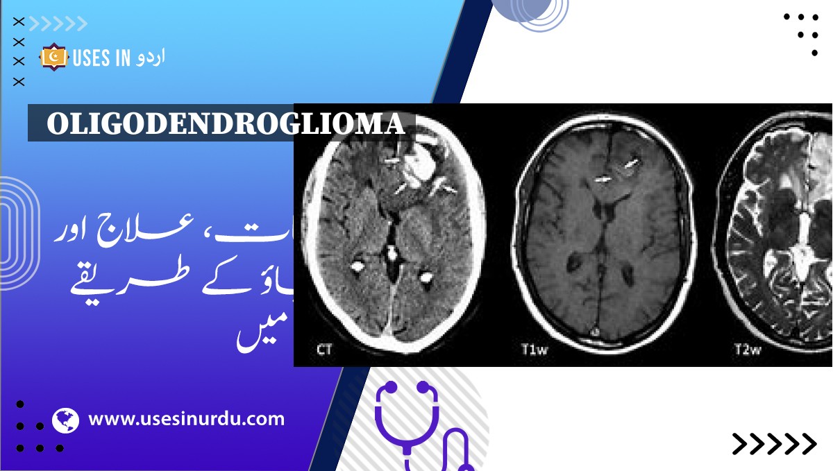 Oligodendroglioma