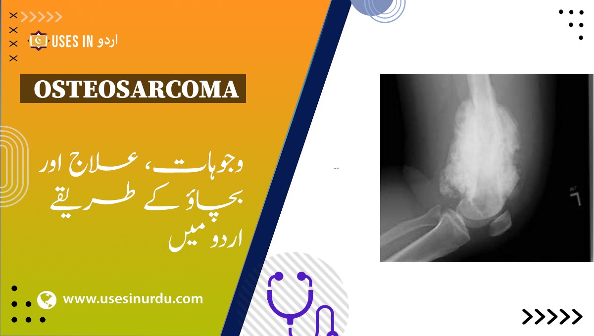 Osteosarcoma