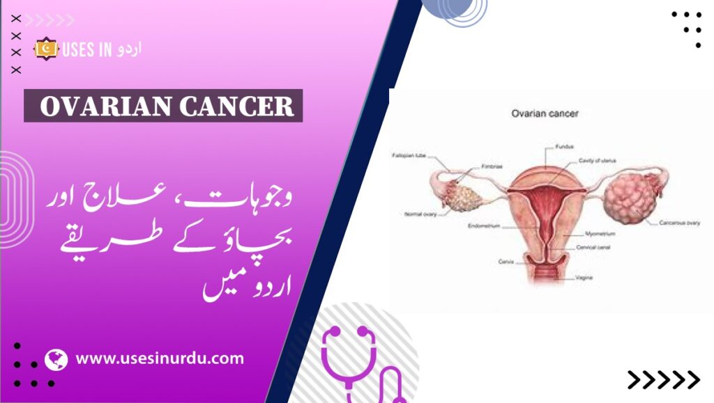 Ovarian Cancer