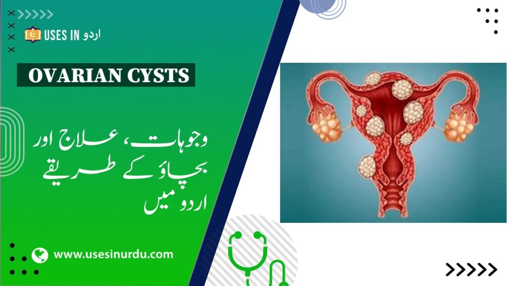 Ovarian Cysts