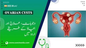 Ovarian Cysts
