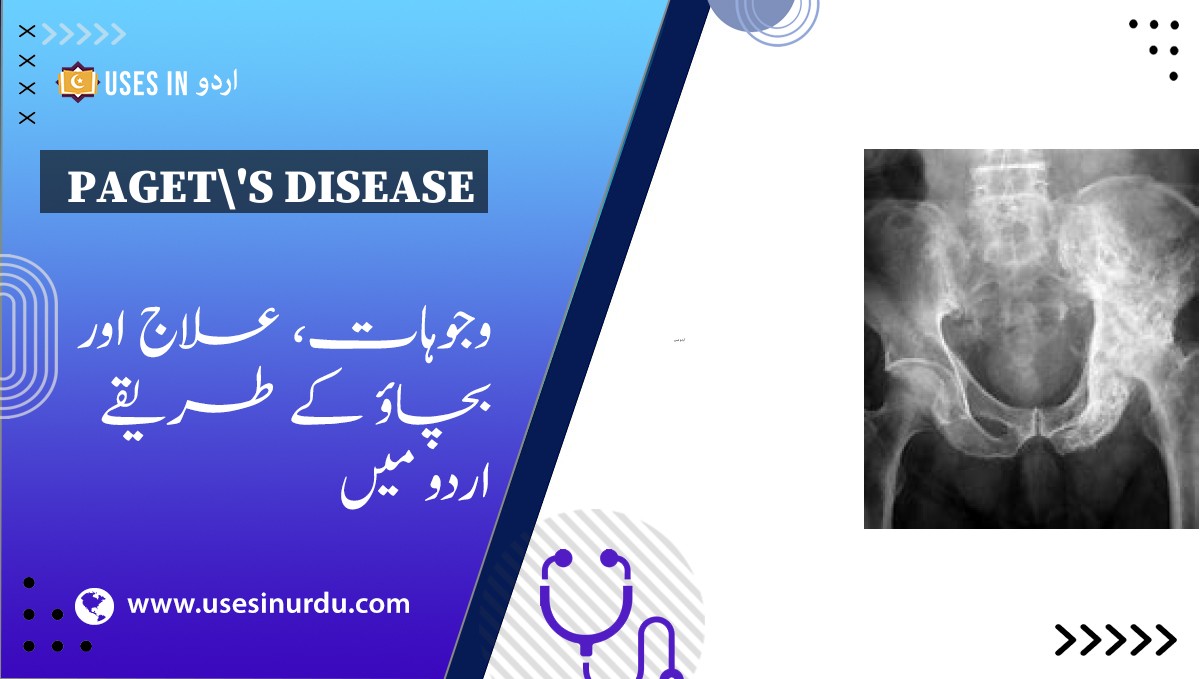 Paget's Disease