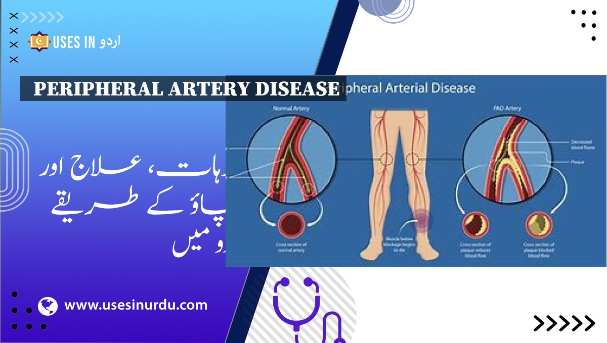 Peripheral Artery Disease