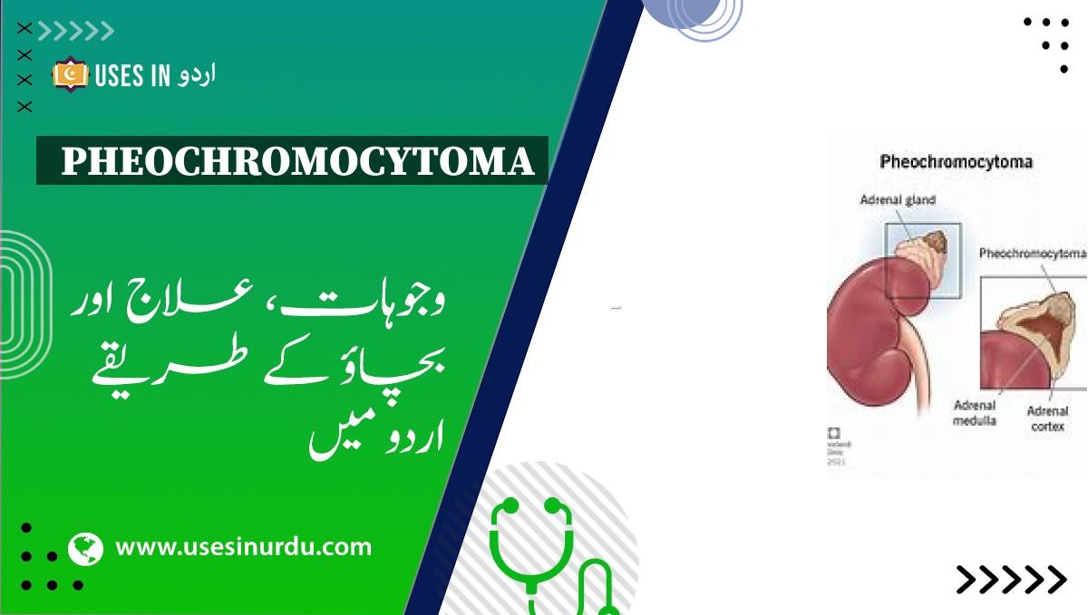 Pheochromocytoma