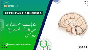Pituitary Adenoma