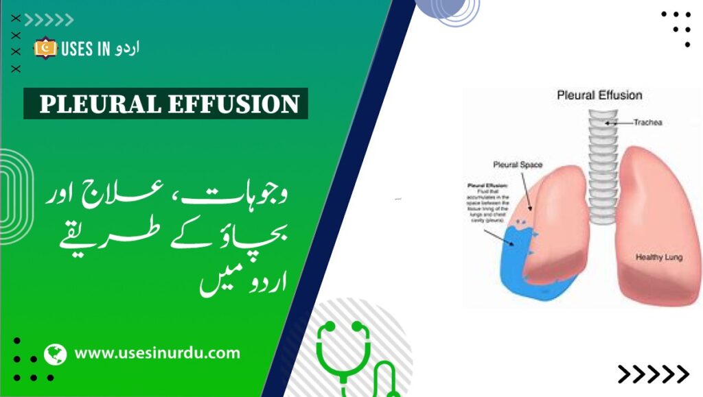 Pleural Effusion