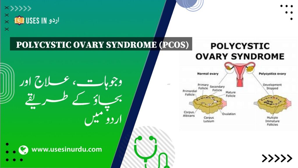 Polycystic Ovary Syndrome (PCOS)