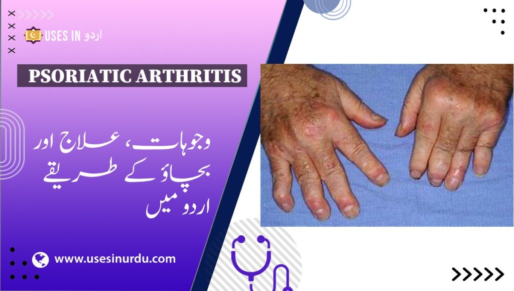 Psoriatic Arthritis