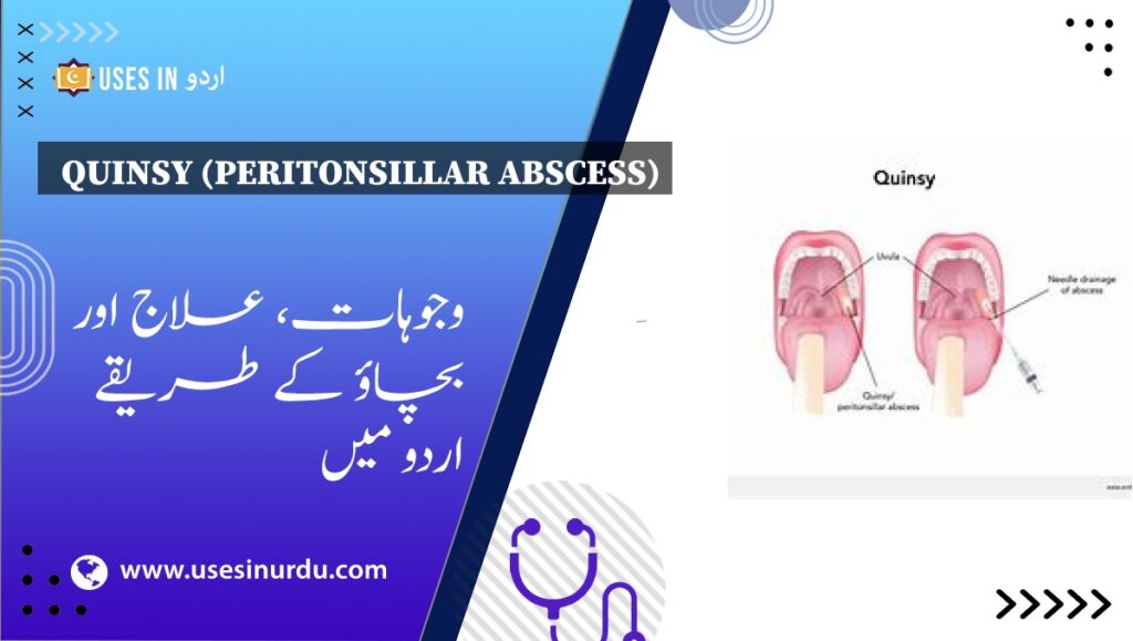 Quinsy (Peritonsillar Abscess)