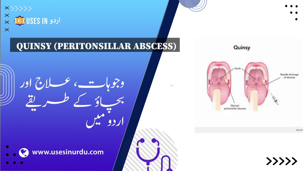 Quinsy (Peritonsillar Abscess)