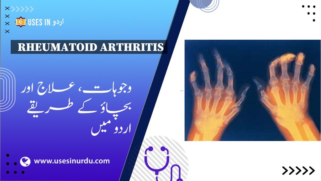 Rheumatoid Arthritis