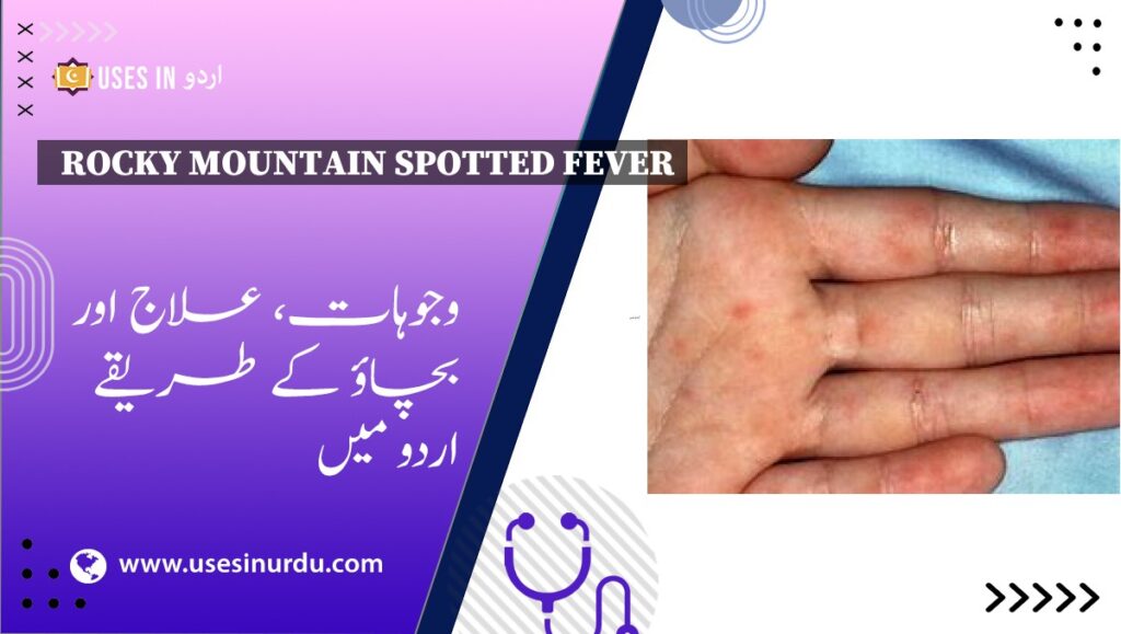 Rocky Mountain Spotted Fever