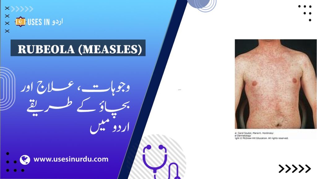 Rubeola (Measles)