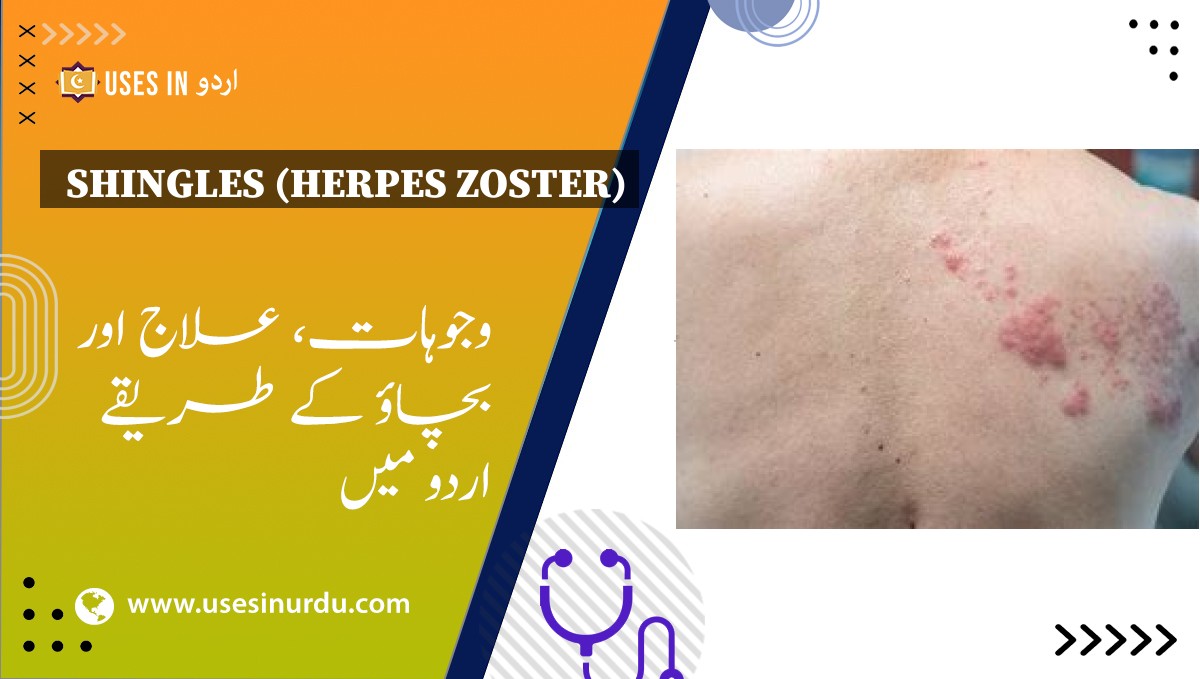 Shingles (Herpes Zoster)