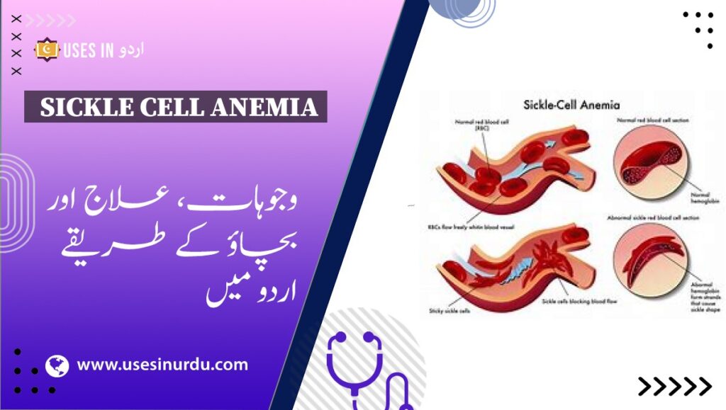 Sickle Cell Anemia