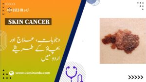 Skin Cancer