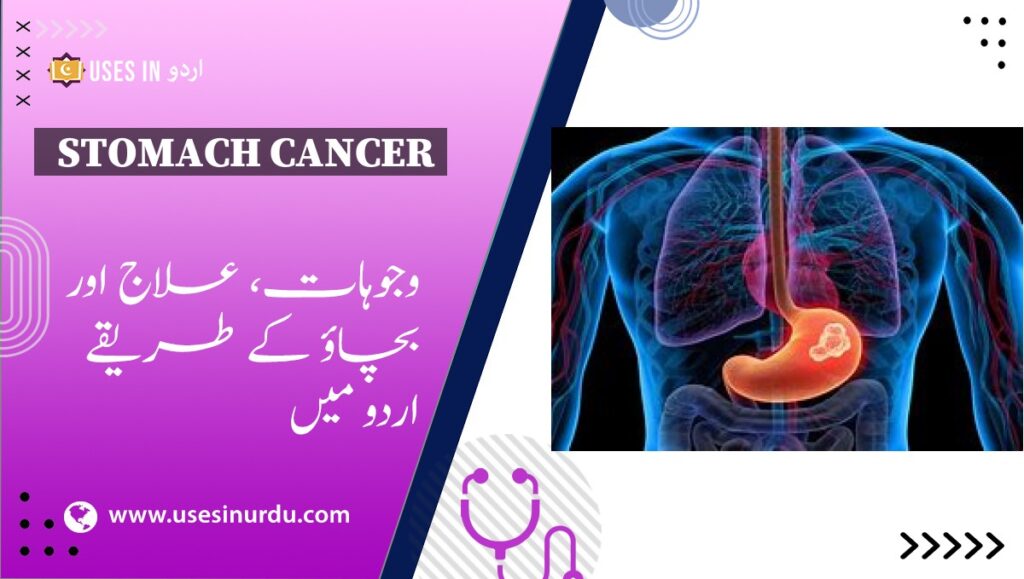 Stomach Cancer