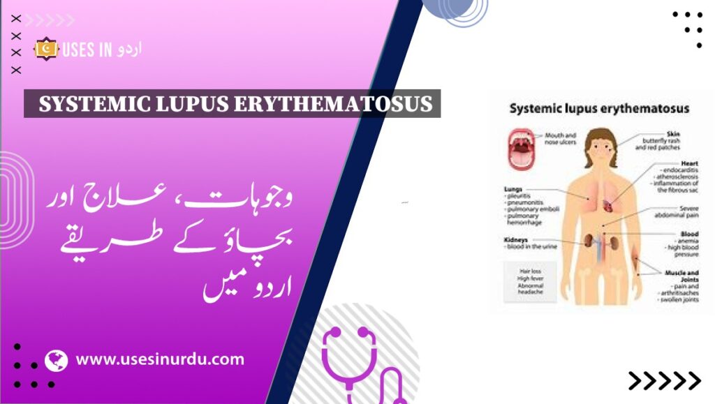 Systemic Lupus Erythematosus