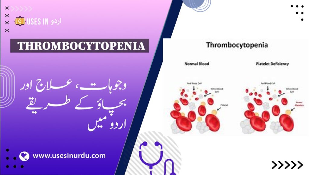 Thrombocytopenia