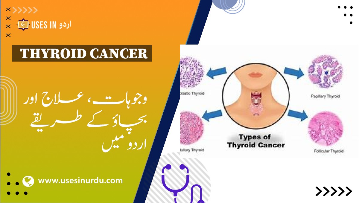 Thyroid Cancer