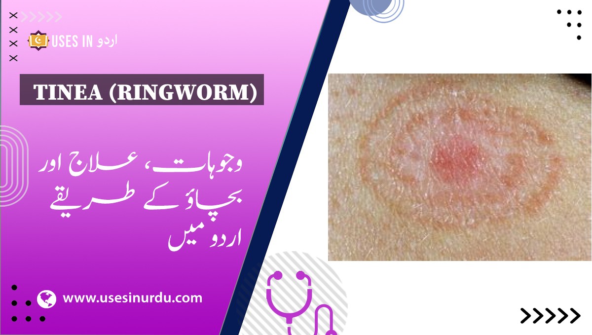 Tinea (Ringworm)