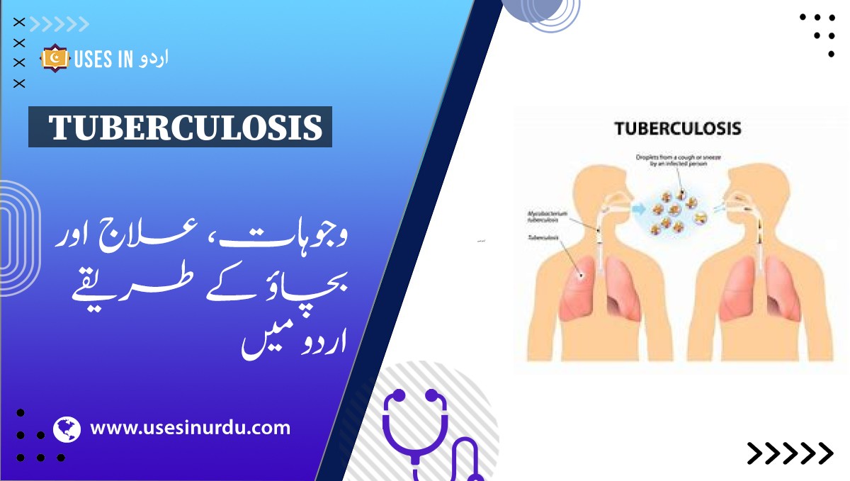 Tuberculosis