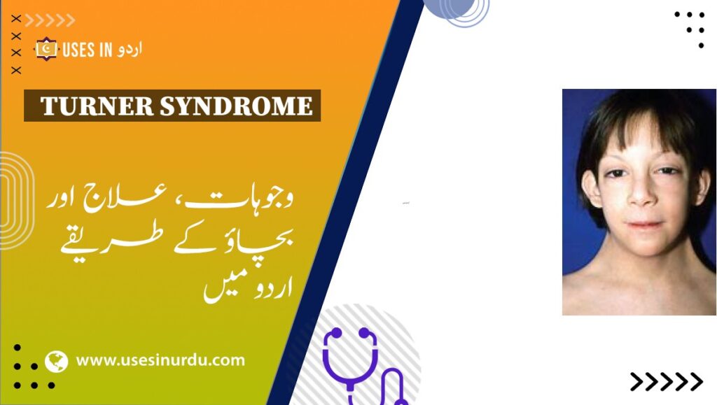 Turner Syndrome