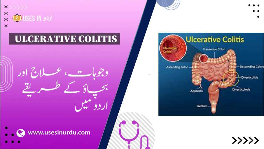 Ulcerative Colitis