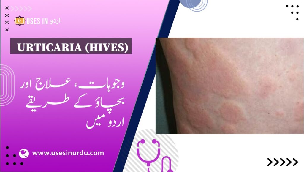 Urticaria (Hives)