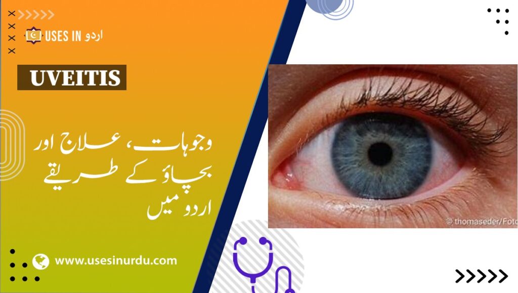 Uveitis