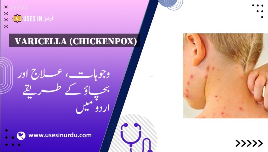 Varicella (Chickenpox)