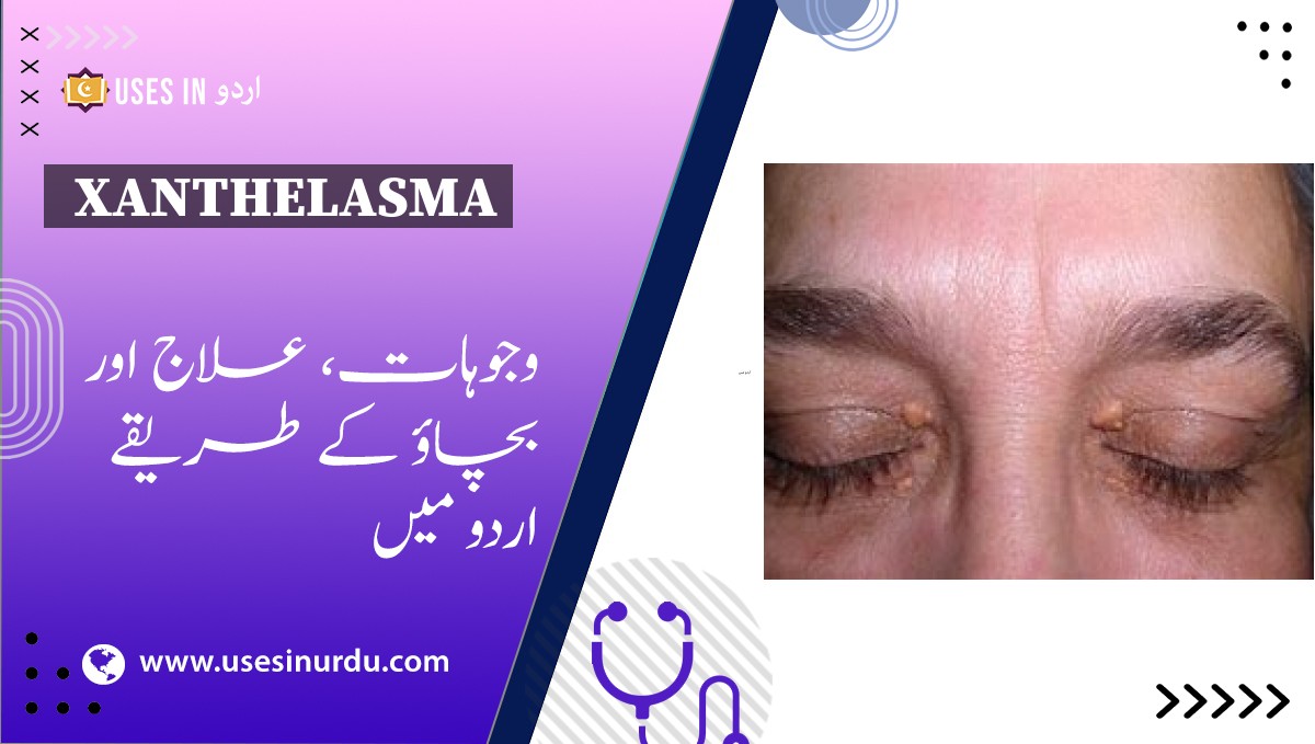 Xanthelasma