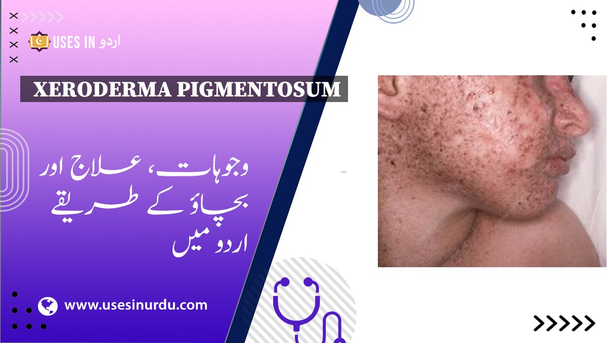 Xeroderma Pigmentosum