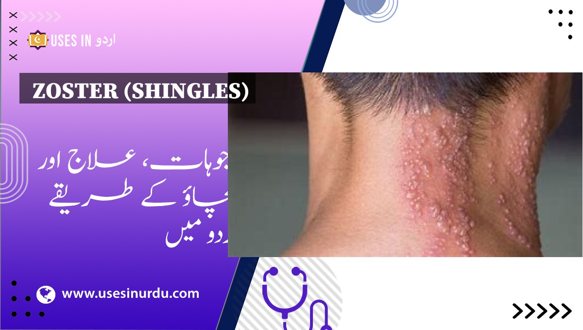 Zoster (Shingles)