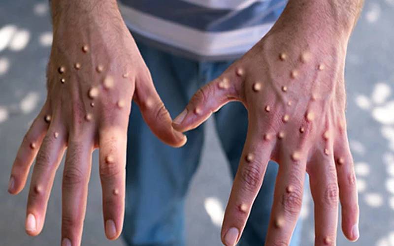 لاہور میں منکی پاکس کا خطرہ سنگین ہوگیا ،24گھنٹوں کے دوران 4 مریض سامنے آگئے